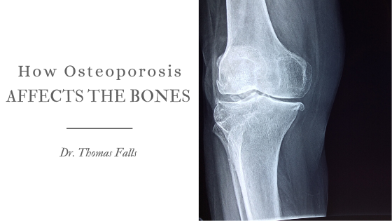 How Osteoporosis Affects the Bones